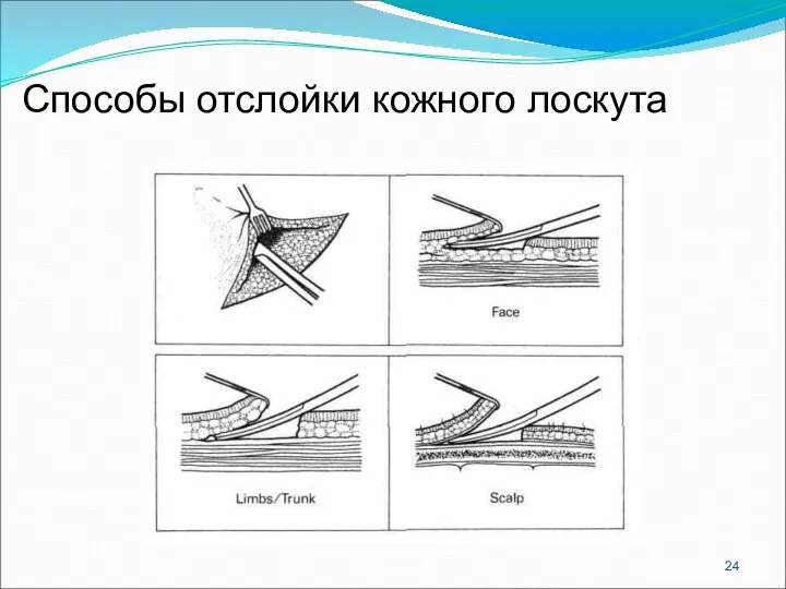 Способы отслойки кожного лоскута