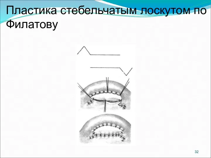 Пластика стебельчатым лоскутом по Филатову