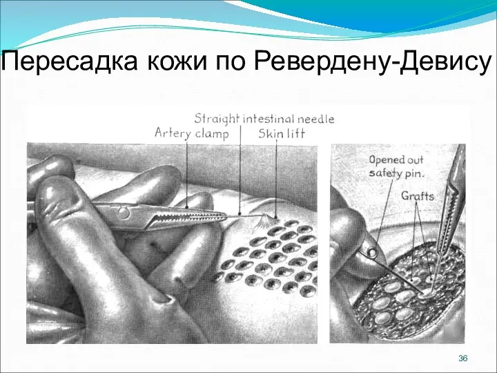 Пересадка кожи по Ревердену-Девису