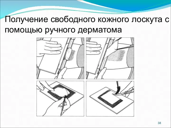 Получение свободного кожного лоскута с помощью ручного дерматома