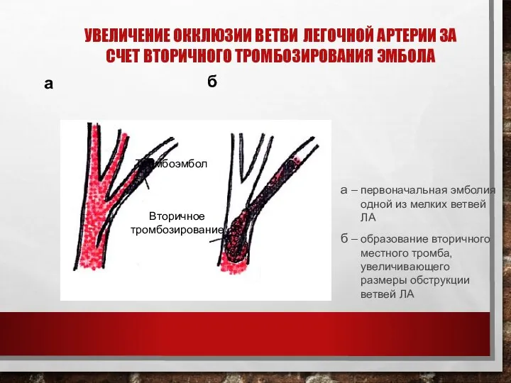 УВЕЛИЧЕНИЕ ОККЛЮЗИИ ВЕТВИ ЛЕГОЧНОЙ АРТЕРИИ ЗА СЧЕТ ВТОРИЧНОГО ТРОМБОЗИРОВАНИЯ ЭМБОЛА Тромбоэмбол