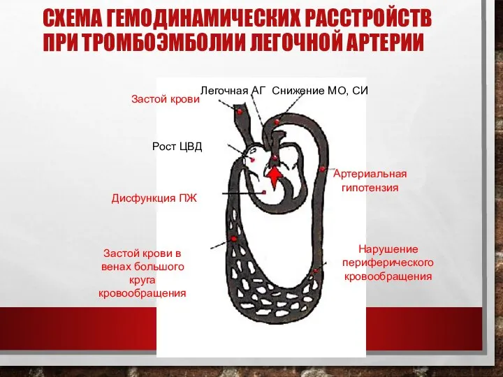 СХЕМА ГЕМОДИНАМИЧЕСКИХ РАССТРОЙСТВ ПРИ ТРОМБОЭМБОЛИИ ЛЕГОЧНОЙ АРТЕРИИ Застой крови Легочная АГ