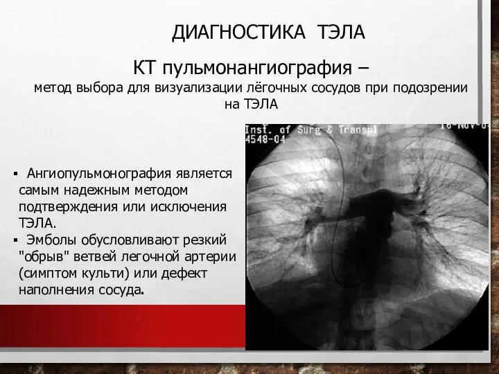 ДИАГНОСТИКА ТЭЛА КТ пульмонангиография – метод выбора для визуализации лёгочных сосудов