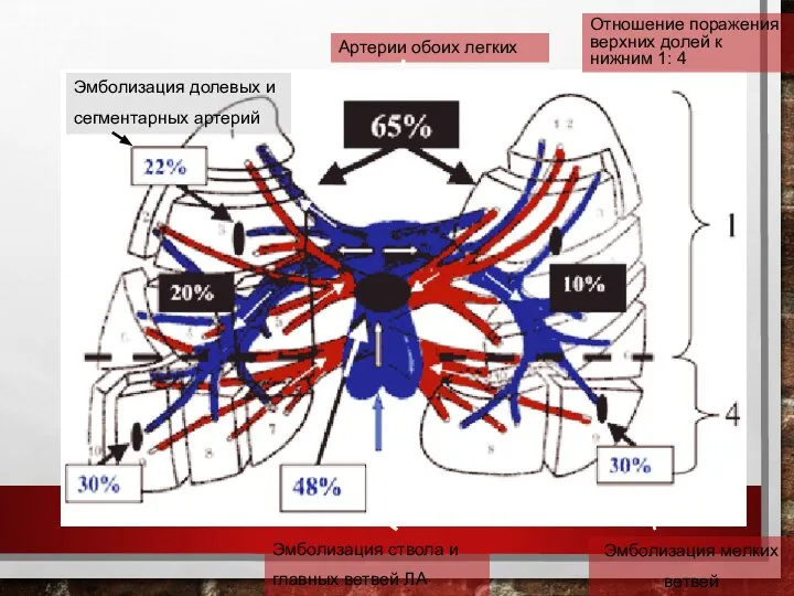Артерии обоих легких Эмболизация ствола и главных ветвей ЛА Эмболизация мелких