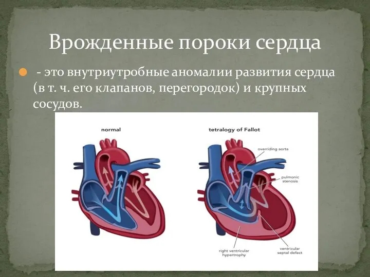 - это внутриутробные аномалии развития сердца (в т. ч. его клапанов,