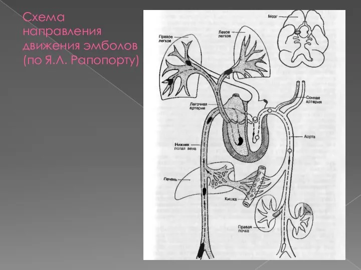 Схема направления движения эмболов (по Я.Л. Рапопорту)