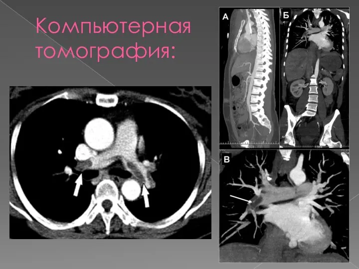 Компьютерная томография: