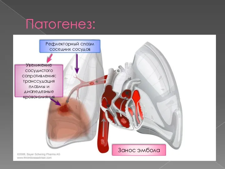 Патогенез: Занос эмбола Увеличение сосудистого сопротивления:транссудация плазмы и диапедезные кровоизлияния Рефлекторный спазм соседних сосудов