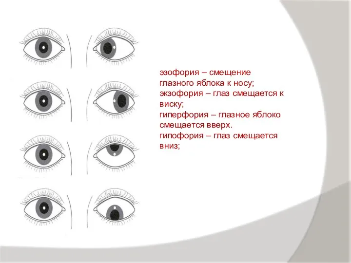 эзофория – смещение глазного яблока к носу; экзофория – глаз смещается