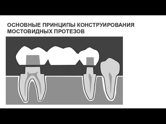 ОСНОВНЫЕ ПРИНЦИПЫ КОНСТРУИРОВАНИЯ МОСТОВИДНЫХ ПРОТЕЗОВ