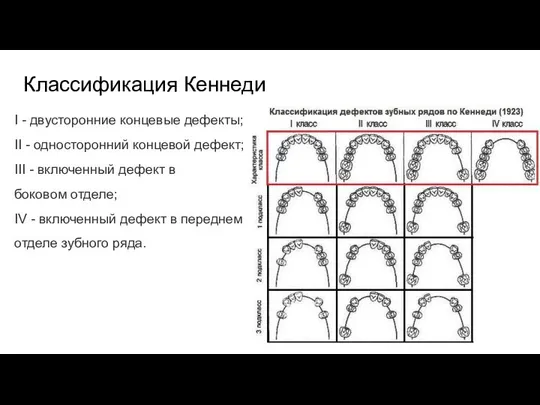 Классификация Кеннеди I - двусторонние концевые дефекты; II - односторонний концевой