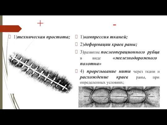 + 1)техническая простота; - 1)компрессия тканей; 2)деформации краев раны; 3)развитие послеоперационного