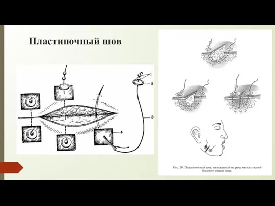 Пластиночный шов