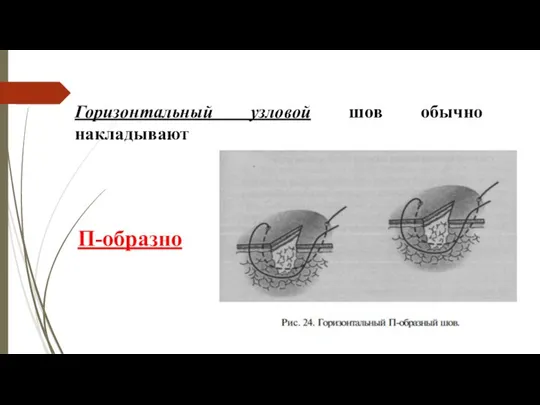 Горизонтальный узловой шов обычно накладывают П-образно