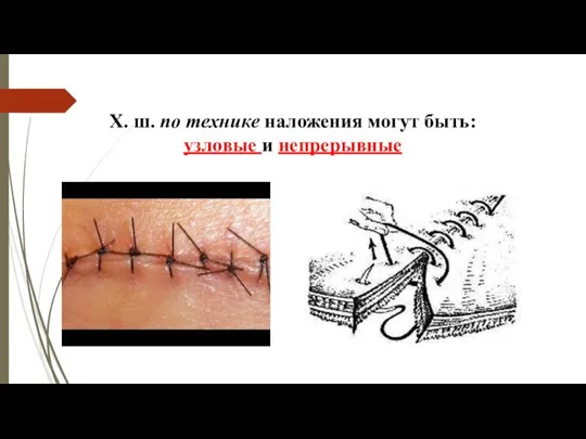 Х. ш. по технике наложения могут быть: узловые и непрерывные