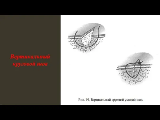 Вертикальный круговой шов