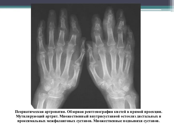 Псориатическая артропатия. Обзорная рентгенография кистей в прямой проекции. Мутилирующий артрит. Множественный