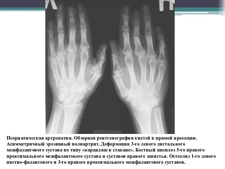 Псориатическая артропатия. Обзорная рентгенография кистей в прямой проекции. Асимметричный эрозивный полиартрит.