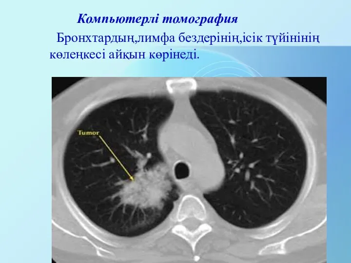 Компьютерлі томография Бронхтардың,лимфа бездерінің,ісік түйінінің көлеңкесі айқын көрінеді.