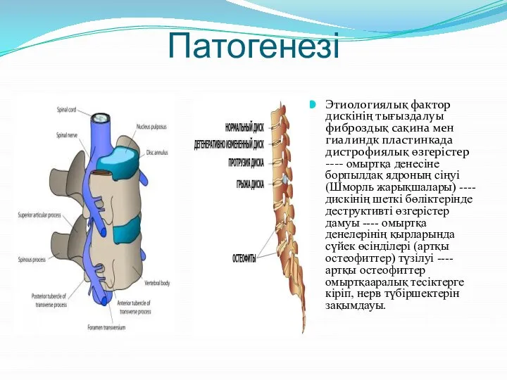 Патогенезі Этиологиялық фактор дискінің тығыздалуы фиброздық сақина мен гиалиндк пластинкада дистрофиялық