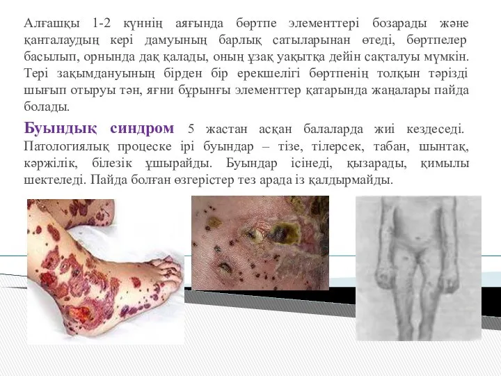 Алғашқы 1-2 күннің аяғында бөртпе элементтері бозарады және қанталаудың кері дамуының