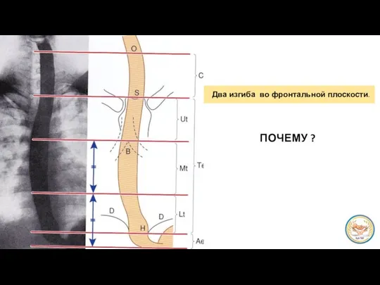 ПОЧЕМУ ? Два изгиба во фронтальной плоскости.