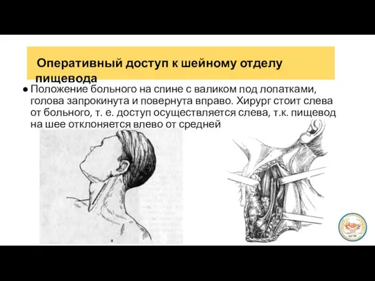 Положение больного на спине с валиком под лопатками, голова запрокинута и