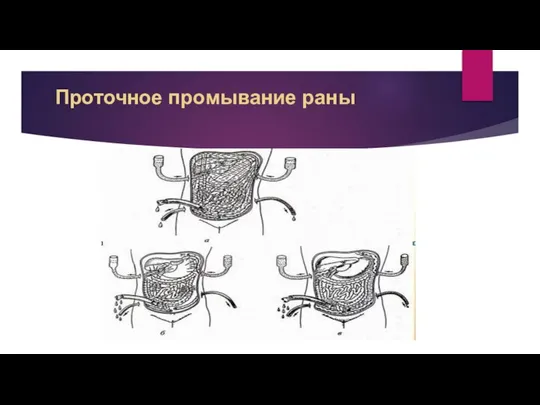 Проточное промывание раны