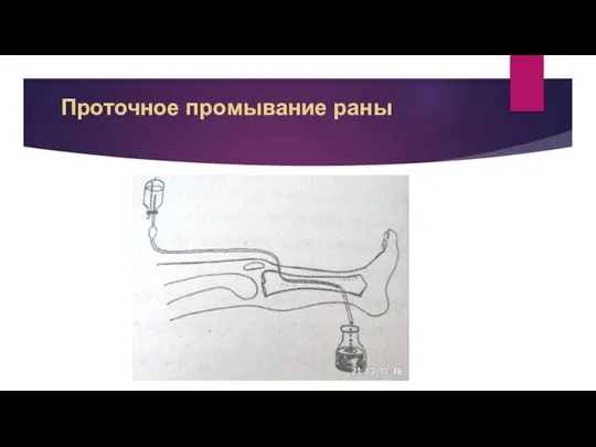 Проточное промывание раны