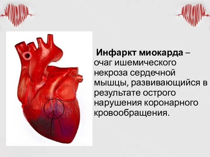 Инфаркт миокарда – очаг ишемического некроза сердечной мышцы, развивающийся в результате острого нарушения коронарного кровообращения.