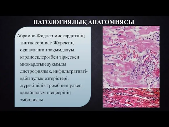 ПАТОЛОГИЯЛЫҚ АНАТОМИЯСЫ Абрамов-Фидлер миокардитінің типтік көрінісі: Жүректің оқшауланған зақымдалуы, кардиосклерозбен тіркескен