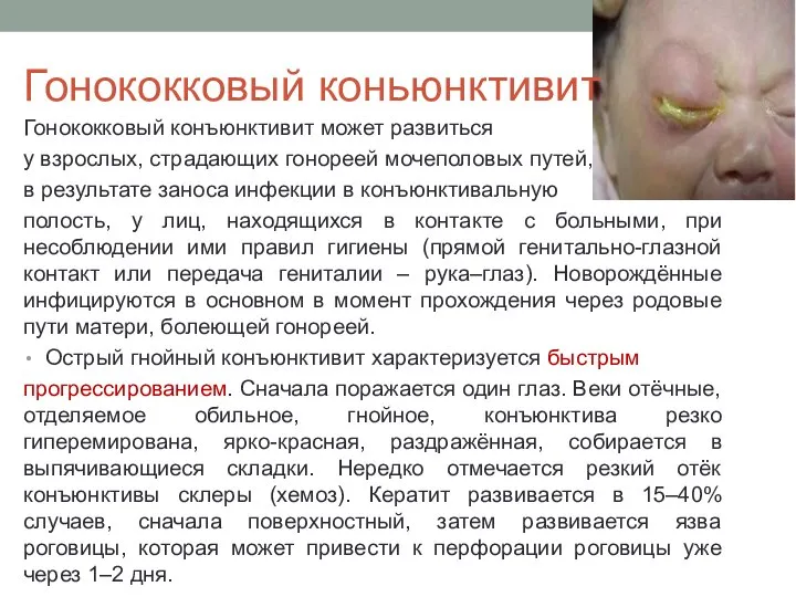 Гонококковый коньюнктивит Гонококковый конъюнктивит может развиться у взрослых, страдающих гонореей мочеполовых