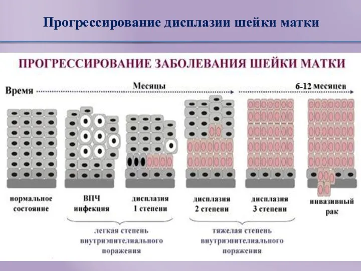 Прогрессирование дисплазии шейки матки