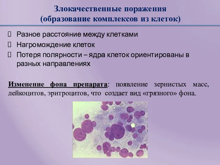 Злокачественные поражения (образование комплексов из клеток) Разное расстояние между клетками Нагромождение