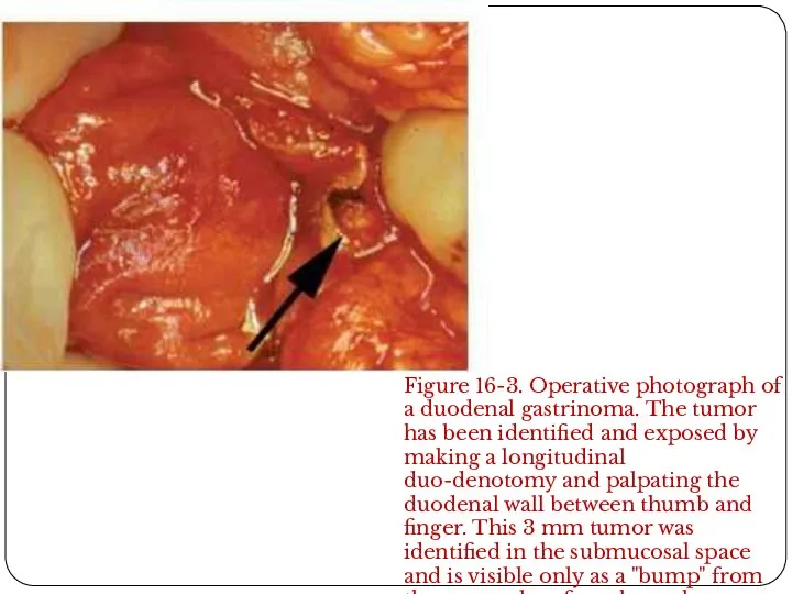 Figure 16-3. Operative photograph of a duodenal gastrinoma. The tumor has