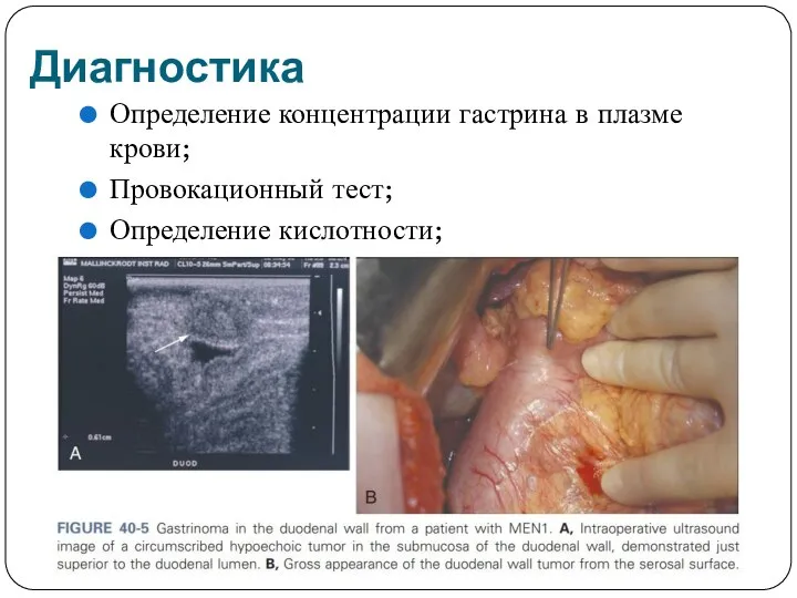 Диагностика Определение концентрации гастрина в плазме крови; Провокационный тест; Определение кислотности;