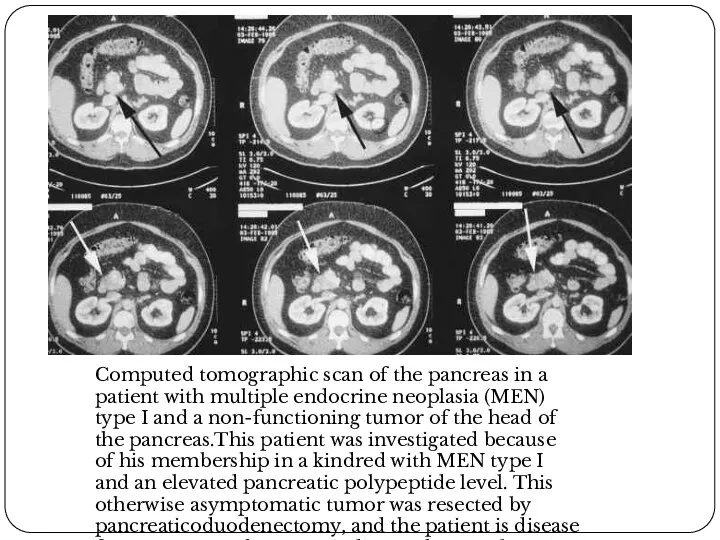 Computed tomographic scan of the pancreas in a patient with multiple