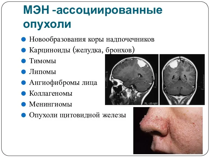 МЭН -ассоциированные опухоли Новообразования коры надпочечников Карциноиды (желудка, бронхов) Тимомы Липомы