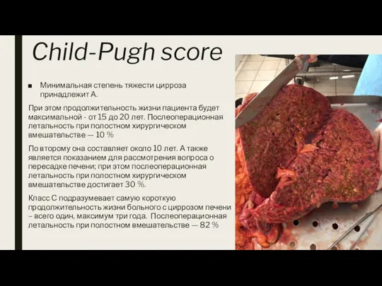 Child-Pugh score Минимальная степень тяжести цирроза принадлежит А. При этом продолжительность