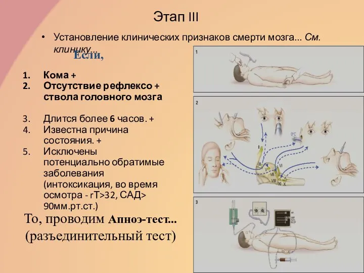 Этап III Установление клинических признаков смерти мозга... См.клинику... Если, Кома +