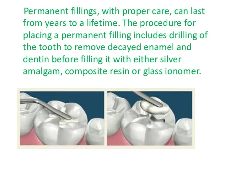 Permanent fillings, with proper care, can last from years to a