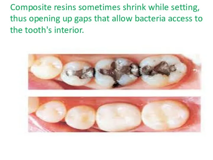 Composite resins sometimes shrink while setting, thus opening up gaps that