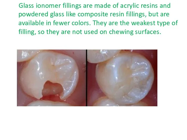 Glass ionomer fillings are made of acrylic resins and powdered glass