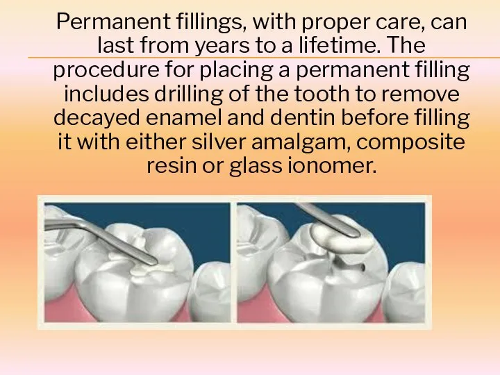 Permanent fillings, with proper care, can last from years to a