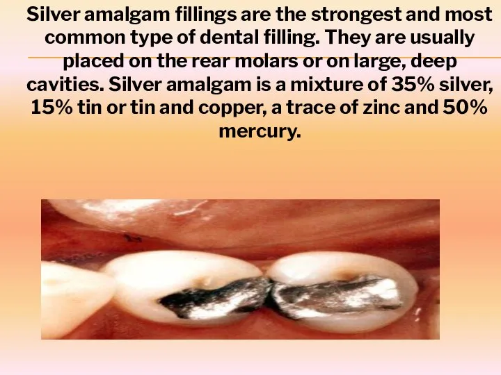 Silver amalgam fillings are the strongest and most common type of