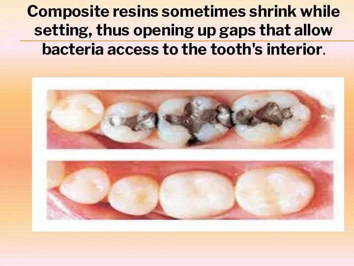 Composite resins sometimes shrink while setting, thus opening up gaps that