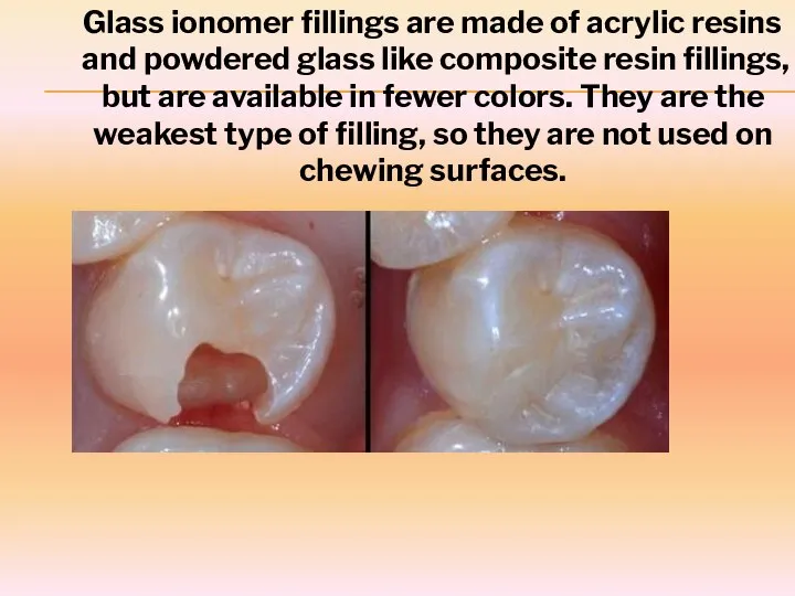 Glass ionomer fillings are made of acrylic resins and powdered glass