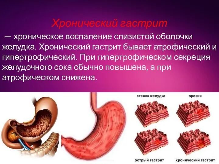 Хронический гастрит — хроническое воспаление слизистой оболочки желудка. Хронический гастрит бывает