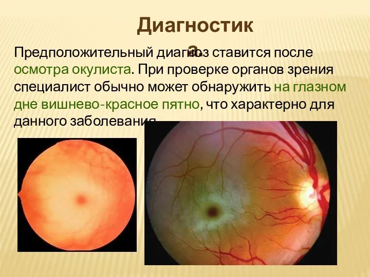Диагностика. Предположительный диагноз ставится после осмотра окулиста. При проверке органов зрения