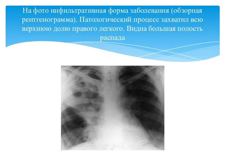 На фото инфильтративная форма заболевания (обзорная рентгенограмма). Патологический процесс захватил всю